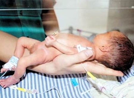 Nguyen nhan bat ngo khien thai nhi gay xuong trong bung me-Hinh-4